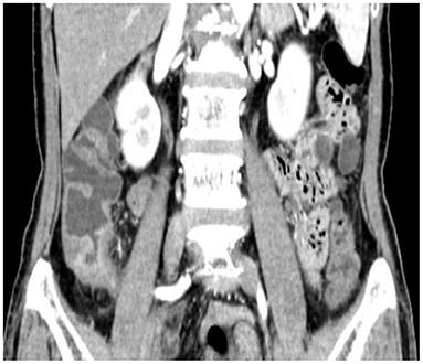 Solitary Cecal Ulcer: A Case Report